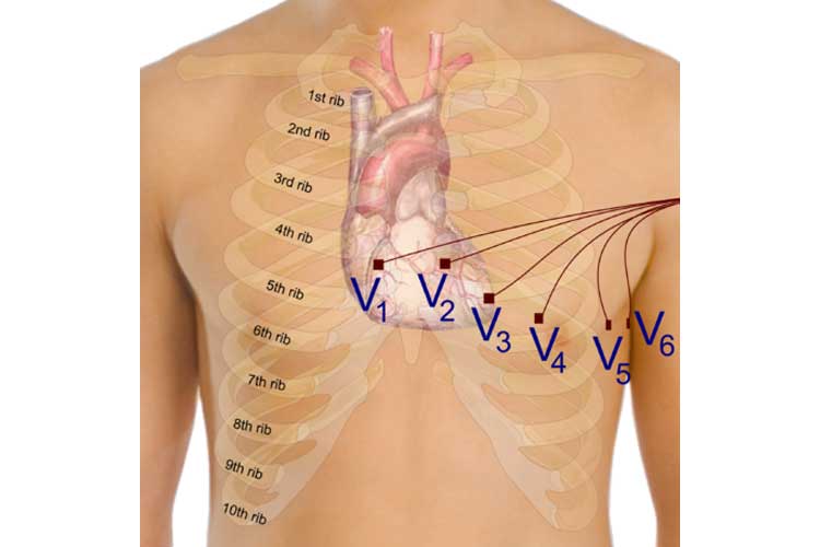 5 lead ecg placement